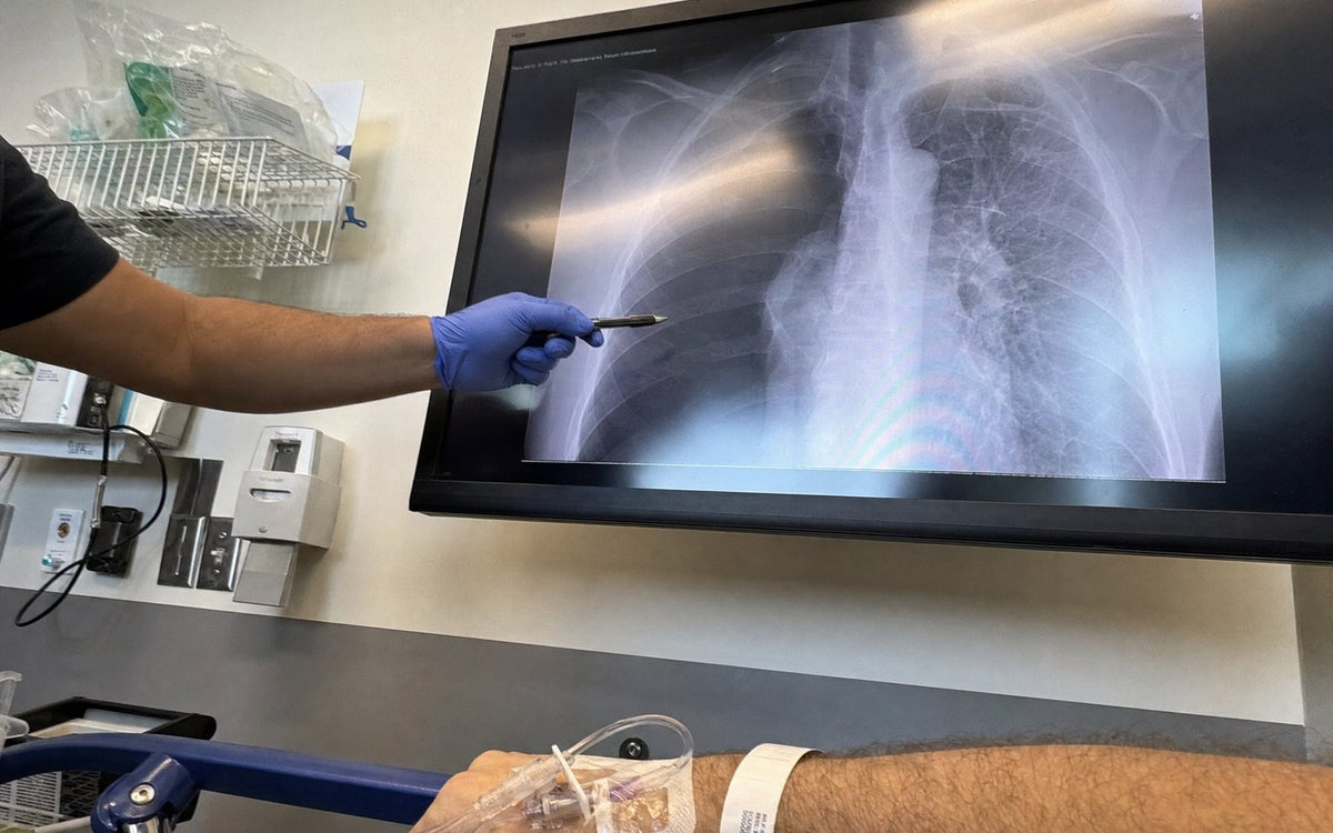 Doctor pointing at a chest X-ray of a collapsed lung on a hospital monitor
